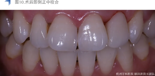 Vitique瓷貼面粘接系統(tǒng)的臨床應用 Vitique瓷貼面粘接系統(tǒng)的臨床應用