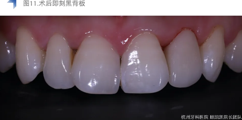 Vitique瓷貼面粘接系統(tǒng)的臨床應用 Vitique瓷貼面粘接系統(tǒng)的臨床應用