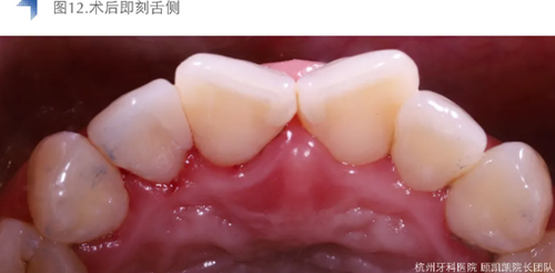 Vitique瓷貼面粘接系統(tǒng)的臨床應用 Vitique瓷貼面粘接系統(tǒng)的臨床應用