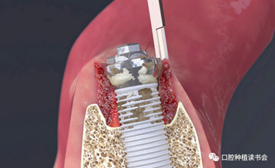 種植體周圍炎的軟硬組織重建治療(上) 種植體周圍炎的軟硬組織重建治療(上)