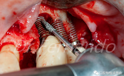 種植體周圍炎的軟硬組織重建治療(上) 種植體周圍炎的軟硬組織重建治療(上)