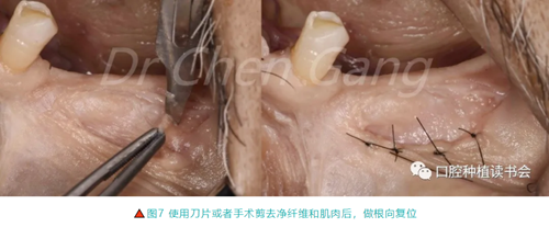 高清圖解|游離牙齦(FGG)的獲取與移植技術(shù) 高清圖解|游離牙齦(FGG)的獲取與移植技術(shù)