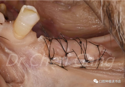 高清圖解|游離牙齦(FGG)的獲取與移植技術(shù) 高清圖解|游離牙齦(FGG)的獲取與移植技術(shù)