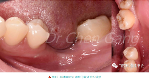 高清圖解|游離牙齦(FGG)的獲取與移植技術(shù) 高清圖解|游離牙齦(FGG)的獲取與移植技術(shù)