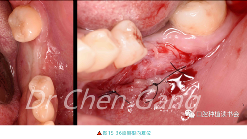 高清圖解|游離牙齦(FGG)的獲取與移植技術(shù) 高清圖解|游離牙齦(FGG)的獲取與移植技術(shù)