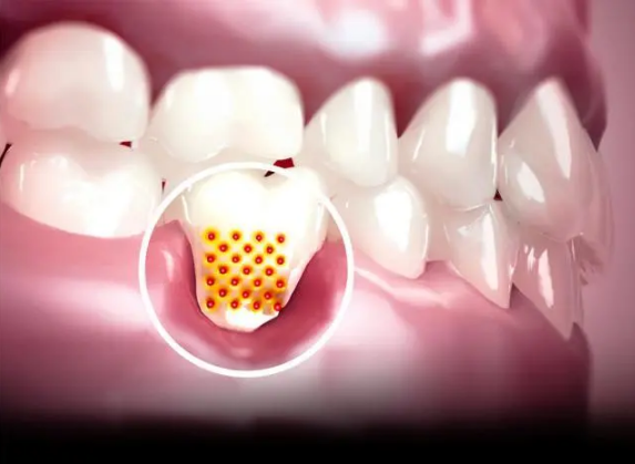 牙周維護(hù) 牙周維護(hù)