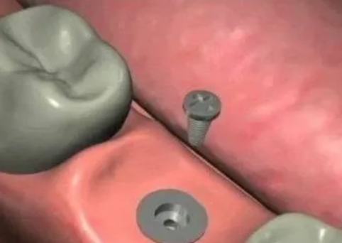 最詳細(xì)的種植牙流程 最詳細(xì)的種植牙流程