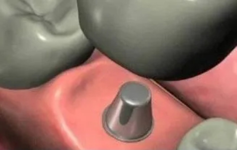 最詳細(xì)的種植牙流程 最詳細(xì)的種植牙流程