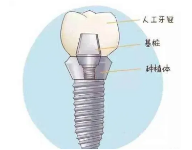 最詳細(xì)的種植牙流程 最詳細(xì)的種植牙流程