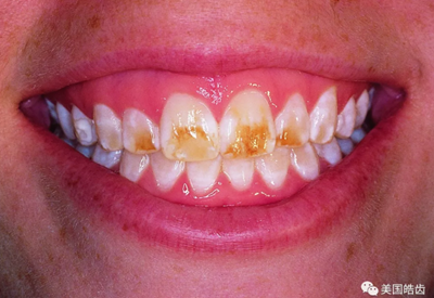 氟斑牙的克星--美國皓齒微創(chuàng)治療法 氟斑牙的克星--美國皓齒微創(chuàng)治療法