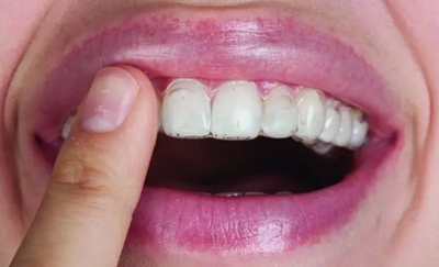 氟斑牙的克星--美國皓齒微創(chuàng)治療法 氟斑牙的克星--美國皓齒微創(chuàng)治療法