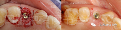 后牙區(qū)即刻種植臨床指南 后牙區(qū)即刻種植臨床指南