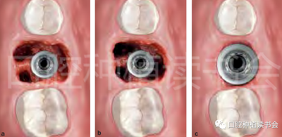 后牙區(qū)即刻種植臨床指南 后牙區(qū)即刻種植臨床指南