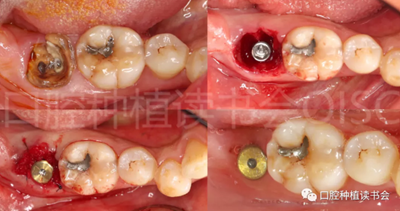 后牙區(qū)即刻種植臨床指南 后牙區(qū)即刻種植臨床指南