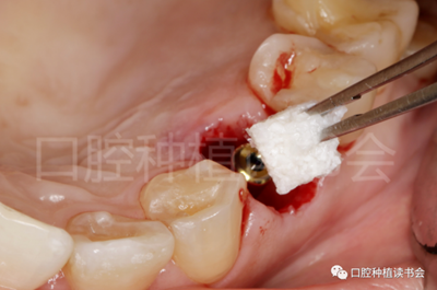 后牙區(qū)即刻種植臨床指南 后牙區(qū)即刻種植臨床指南
