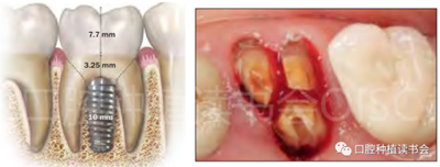 后牙區(qū)即刻種植臨床指南 后牙區(qū)即刻種植臨床指南