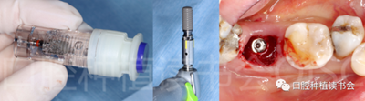 后牙區(qū)即刻種植臨床指南 后牙區(qū)即刻種植臨床指南
