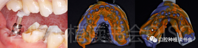 后牙區(qū)即刻種植臨床指南 后牙區(qū)即刻種植臨床指南