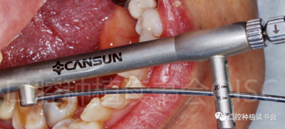 后牙區(qū)即刻種植臨床指南 后牙區(qū)即刻種植臨床指南