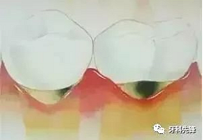 	牙齦萎縮是不治之癥？緩解牙齦萎縮5步走！