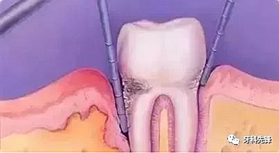 	牙齦萎縮是不治之癥？緩解牙齦萎縮5步走！