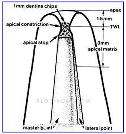 巧用牙膠尖，防止充填時發(fā)生超充或欠充