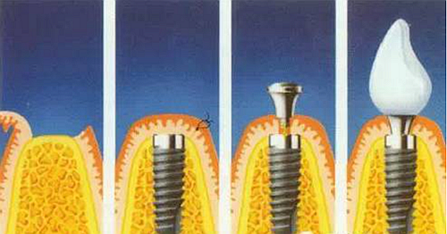 淺談種植牙的適應(yīng)癥、禁忌、程序與未來(lái)趨勢(shì)