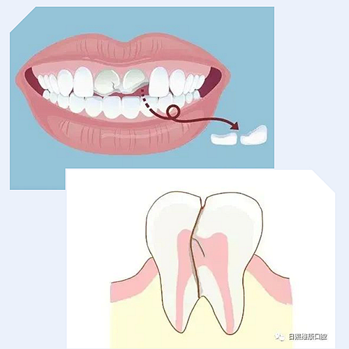 口腔科普 | 殘根殘冠怎么辦——樁核冠 口腔科普 | 殘根殘冠怎么辦——樁核冠