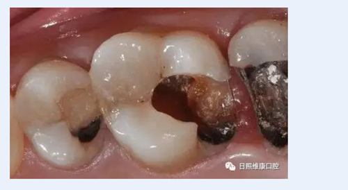 口腔科普 | 殘根殘冠怎么辦——樁核冠 口腔科普 | 殘根殘冠怎么辦——樁核冠