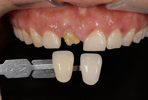 妙手牙醫(yī)丨殘根、殘冠還有保留的意義嗎？