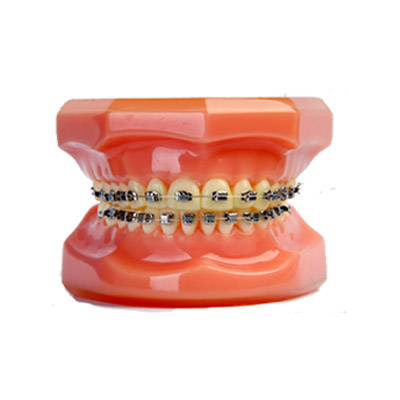 自鎖正畸托槽(杭州杰特全封閉型) 自鎖正畸托槽(杭州杰特全封閉型)