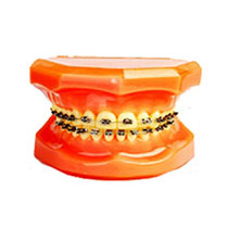 杰特半封閉型自鎖正畸托槽 杰特半封閉型自鎖正畸托槽