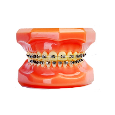 杰特全封閉型自鎖正畸托槽 杰特全封閉型自鎖正畸托槽