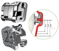 杭州普特自鎖托槽 杭州普特自鎖托槽